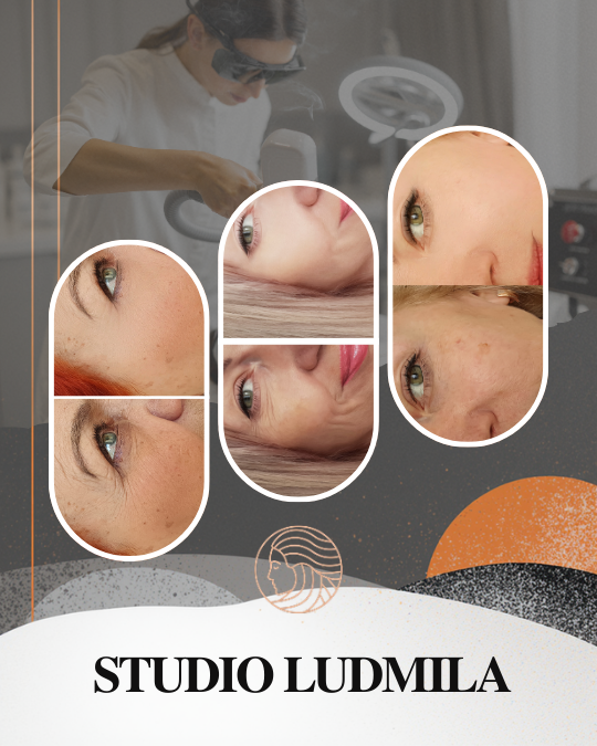 Карбоновый пилинг фото до и после