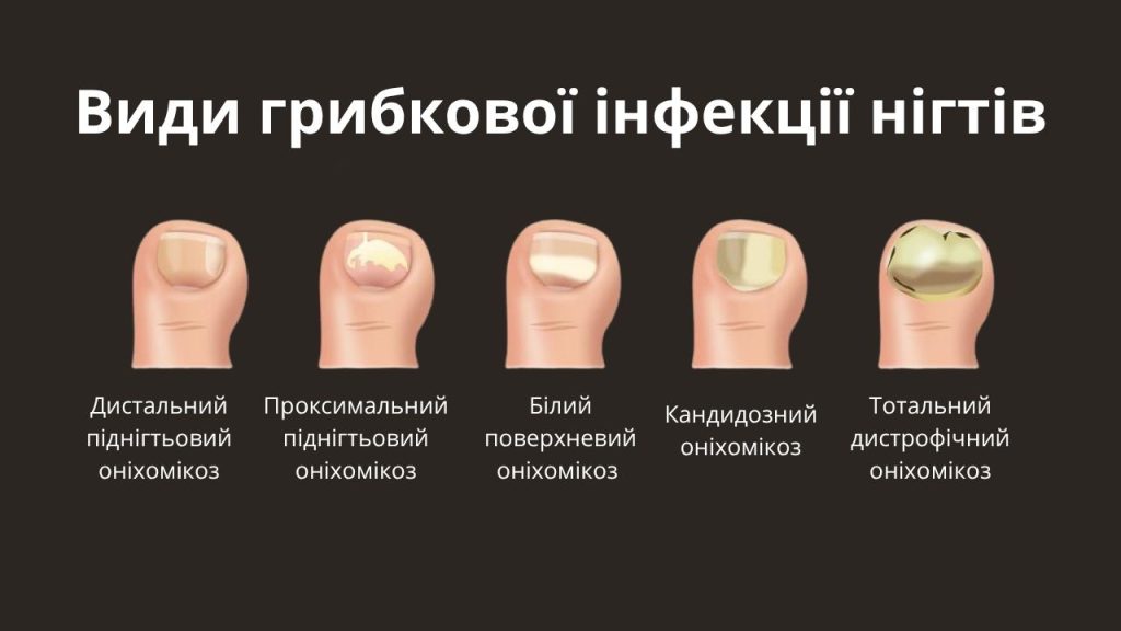 Види грибкової інфекції нігтів