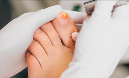 Лазерне лікування грибка нігтів